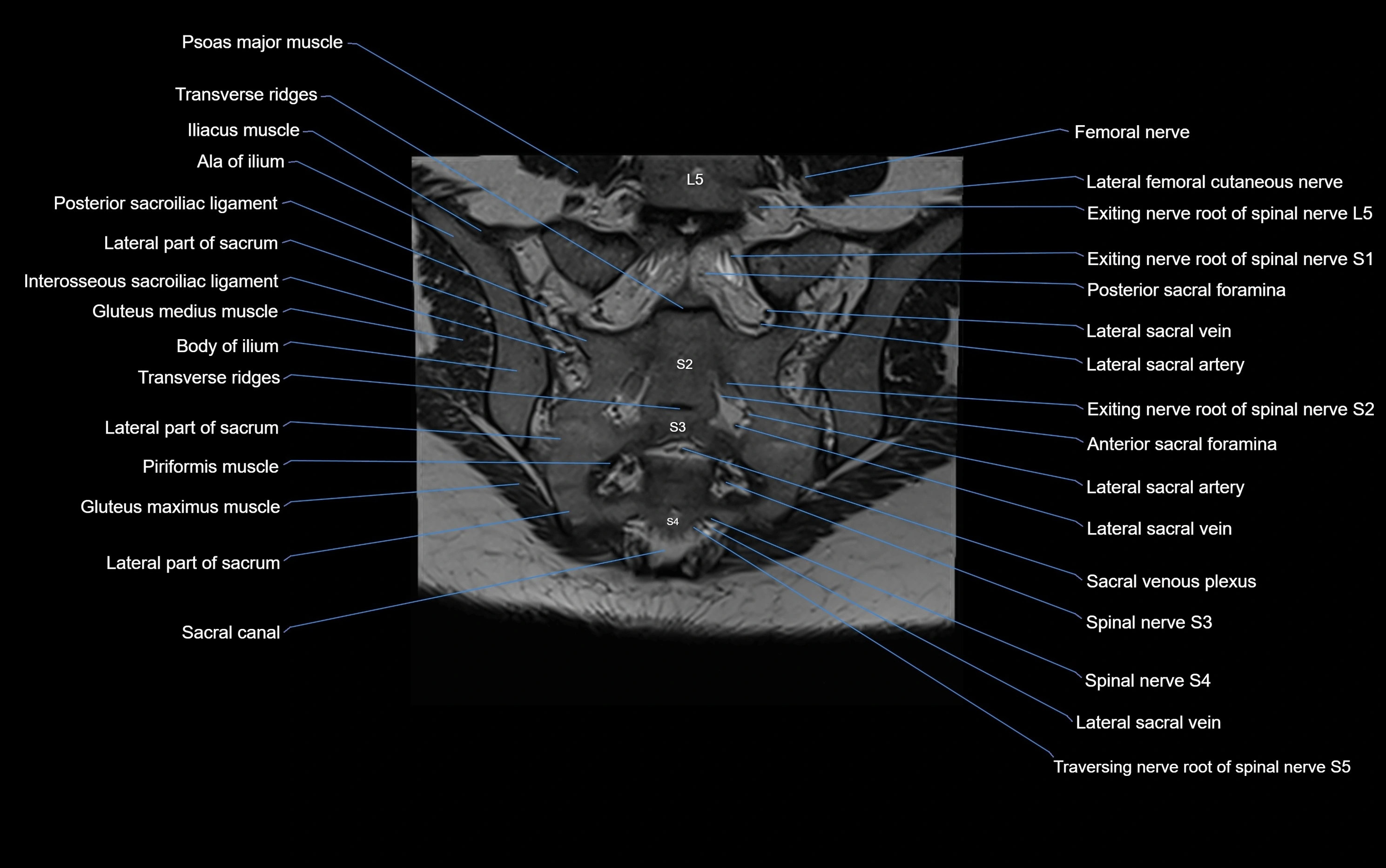 MRI sacroiliac joint coronal cross sectional anatomy  radiology  image-img-00001-00021.webp